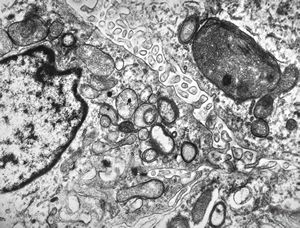 M,1y. | plexus papilloma